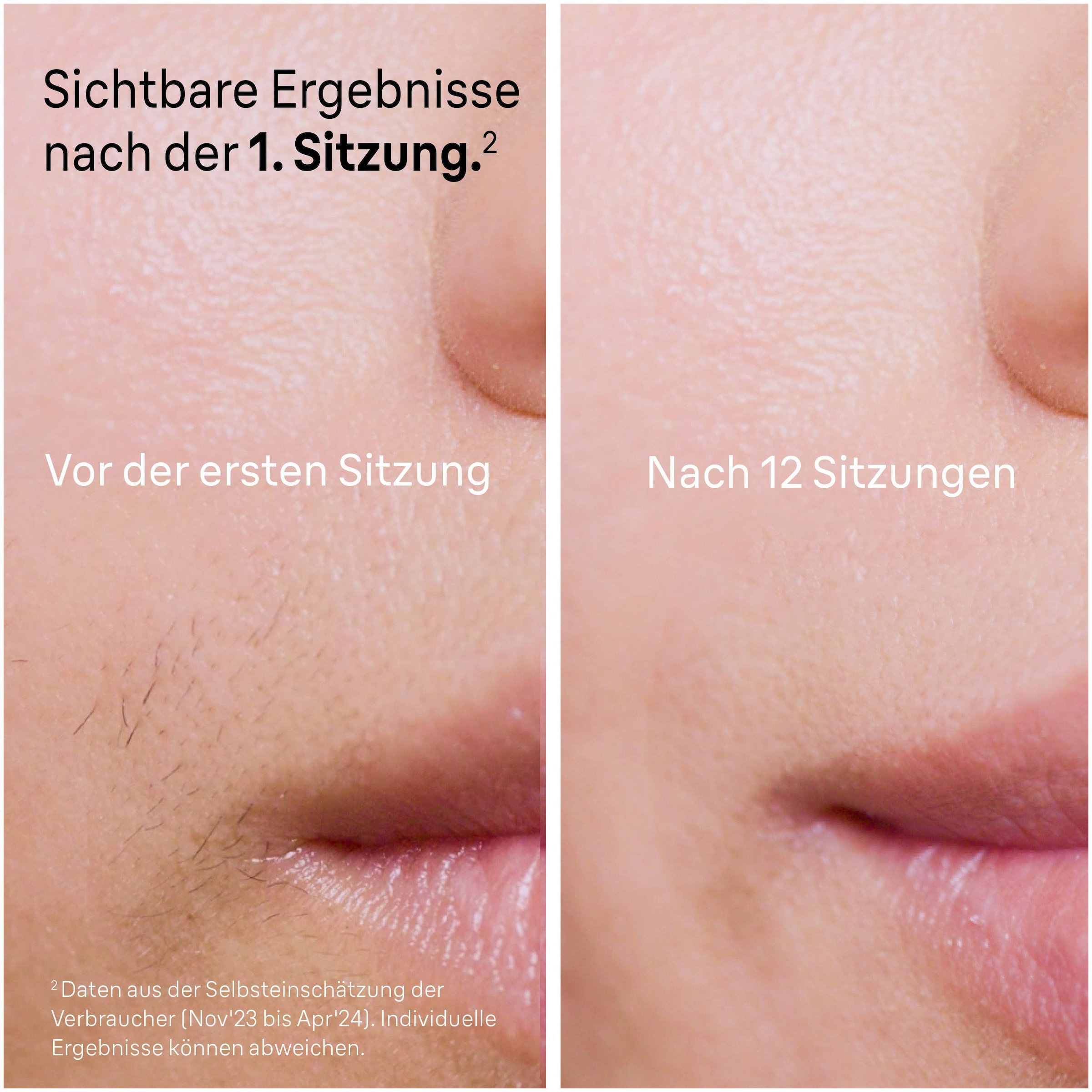 Braun IPL-Haarentferner »Smart Skin i·expert PL7147«, 2 Aufsätze für Gesicht & Körper, Venus Rasierer & Aufbewahrungstasche