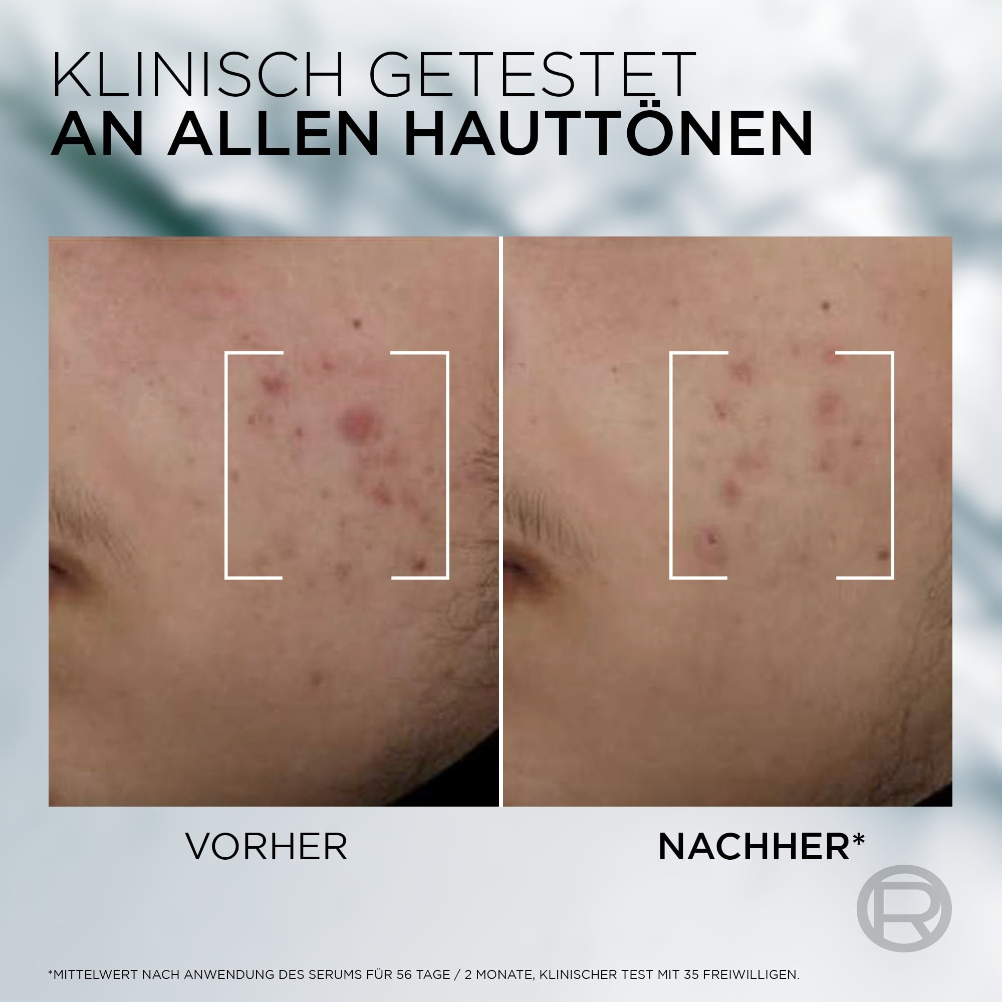 L'ORÉAL PARIS MEN EXPERT Pflegestift »L'Oréal Men Expert Derma Control Niacinamide Anti-Unreinheiten Serum«