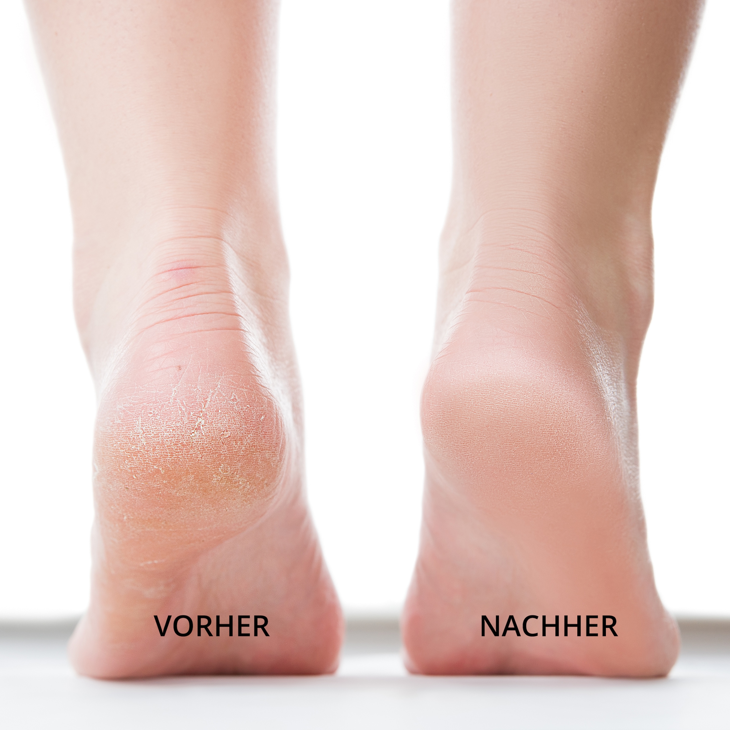 AILORIA Elektrischer Hornhautentferner »USB Hornhautentferner LUSTRE PRO«