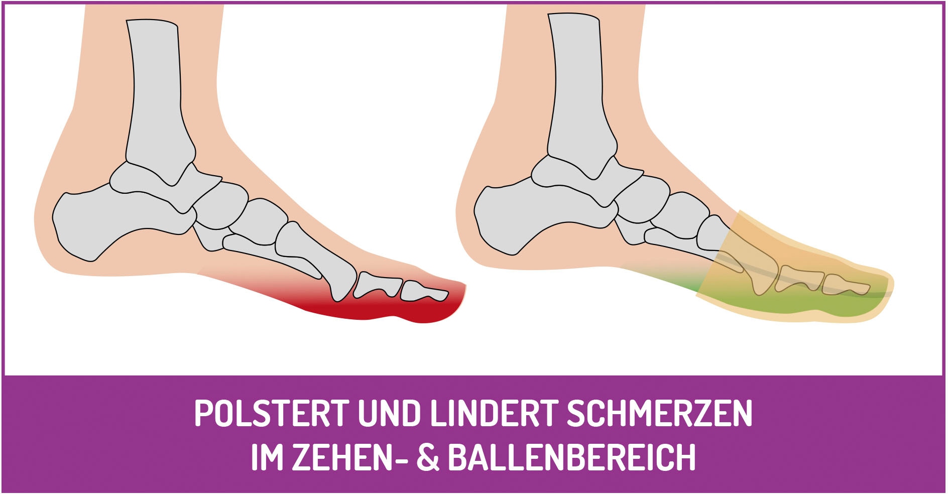 Fußgut Fußpolster »Zehenkappen "Supersoft"«, bei Verletzungen, Hallux valgus, Blasen, Hühneraugen, Ballenschmerzen